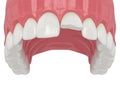 3d render of upper jaw with broken incisor tooth Royalty Free Stock Photo