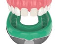 3d render of upper jaw with dental impression tray