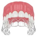 3d render of upper jaw with invisalign removable retainer Royalty Free Stock Photo