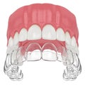 3d render of upper jaw with invisalign removable retainer