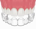 3d render of upper jaw with invisalign removable retainer Royalty Free Stock Photo