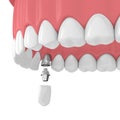 3d render of upper jaw with teeth and dental canine implant Royalty Free Stock Photo