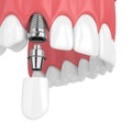 3d render of upper jaw with teeth and dental canine implant Royalty Free Stock Photo