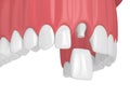 3d render of upper jaw with teeth and dental incisor crown