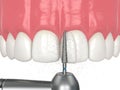 3d render of using a dental drill to shape the tooth and remove excess resin