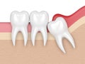 3d render of wisdom mesial impaction with pericoronitis