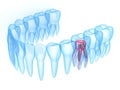 3d render of x-ray teeth with stainless steel dental post