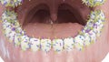 Bacteria on the teeth Royalty Free Stock Photo