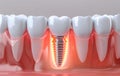 3D rendered illustration of dental implants. Single dental implant is placed in the lower arch of the mouth