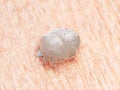 a scabies mite Royalty Free Stock Photo
