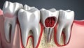 3D Rendered Image of a Dental Implant in Place