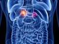 Adrenal gland cancer Royalty Free Stock Photo