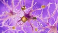 A alzheimer nerve cell Royalty Free Stock Photo