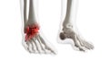 an arthritic ankle joint Royalty Free Stock Photo