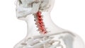 an arthritic cervical spine