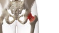 An arthritic hip joint