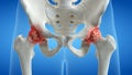 An arthritic hip joint