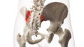 An arthritic iliosacral joint Royalty Free Stock Photo