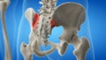 An arthritic iliosacral joint