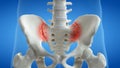 An arthritic iliosacral joint