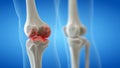 An arthritic knee joint Royalty Free Stock Photo