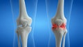 An arthritic knee joint