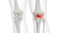 an arthritic knee joint Royalty Free Stock Photo