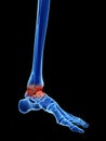 Arthrosis in the ankle