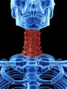 Arthrosis in the cervical