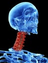 Arthrosis in the cervical spine