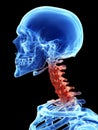 Arthrosis in the cervical spine