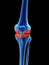 Arthrosis in the knee Royalty Free Stock Photo