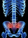 Arthrosis in the sacrum