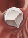 An artificial heart valve Royalty Free Stock Photo