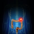 colon cancer Royalty Free Stock Photo