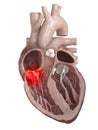 A diseased heart valve Royalty Free Stock Photo