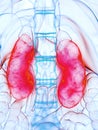 Diseased kidneys Royalty Free Stock Photo
