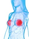 Diseased mammary glands