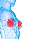 Diseased mammary glands