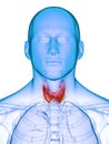 A diseased thyroid gland