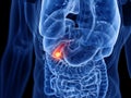 The gallbladder cancer