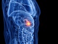the gallbladder cancer