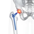 A hip replacement