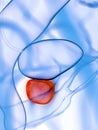 An inflamed prostate