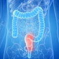 An inflamed rectum