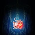 intestine cancer