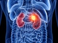 Kidney cancer