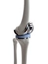 a knee replacement Royalty Free Stock Photo