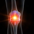 A knee replacement Royalty Free Stock Photo