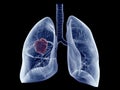 A lung tumor Royalty Free Stock Photo